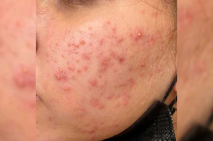 https://www.digitalmex.mx/images/2026/JULIO/19/acne.jpg