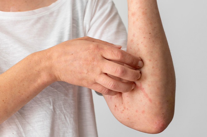 Primera muerte por sarampión en CDMX alerta sobre la importancia de la vacunación en niños y población vulnerable.