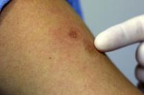 Para evitar contagios es importante lavarse las manos, usar cubrebocas, no tocar las lesiones en la piel, limpiar y desinfectar objetos y evitar compartir alimentos.