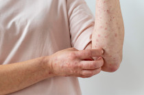 Lesiones características del sarampión, una enfermedad viral altamente contagiosa que puede prevenirse mediante la vacunación, según alertó la OPS ante el aumento de casos en América.