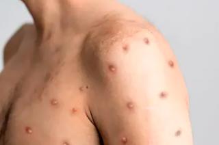 Las personas infectadas se encuentran en sus domicilios con vigilancia epidemiológica.